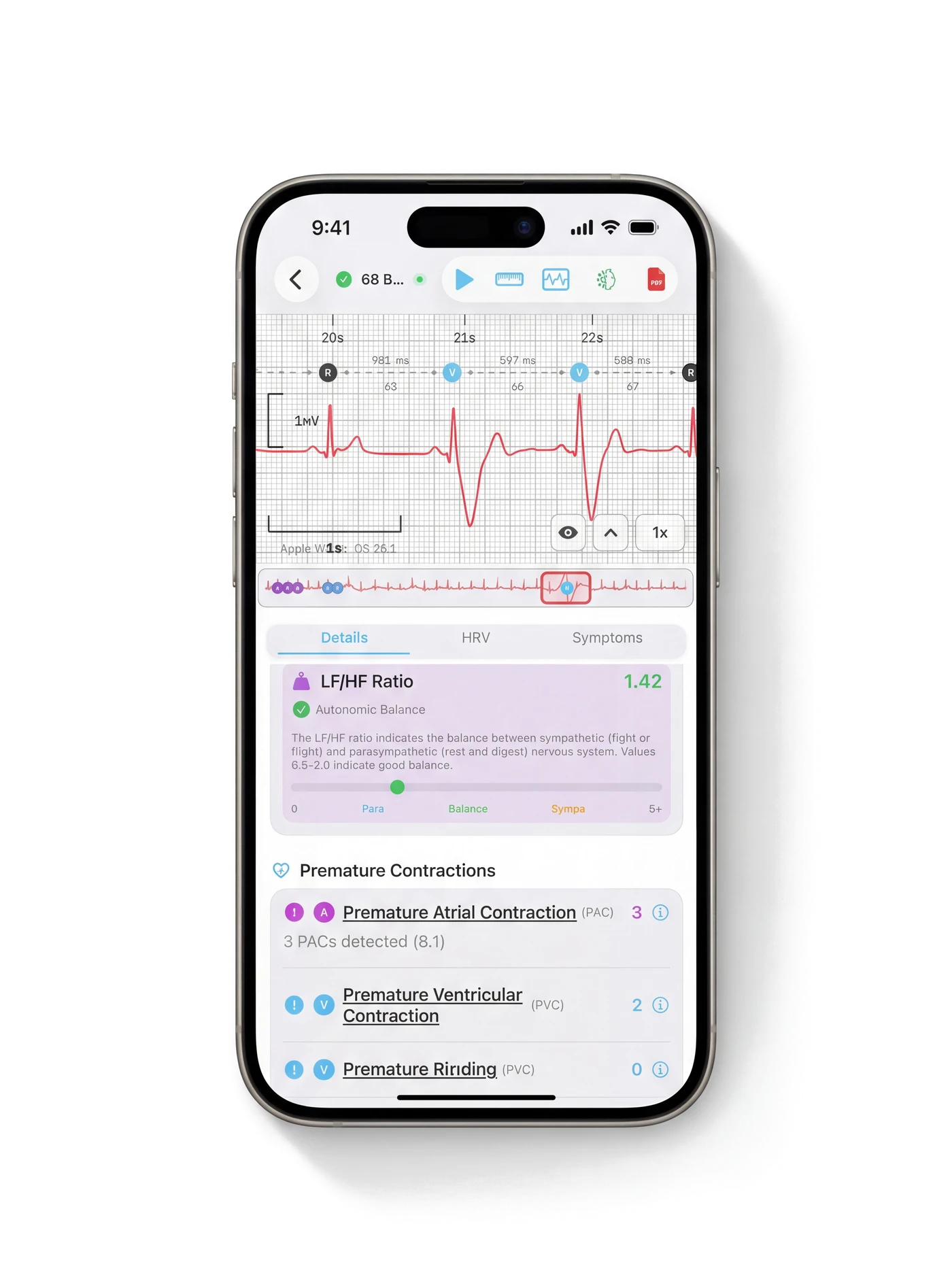 ECG Analysis with waveform and PAC/PVC detection